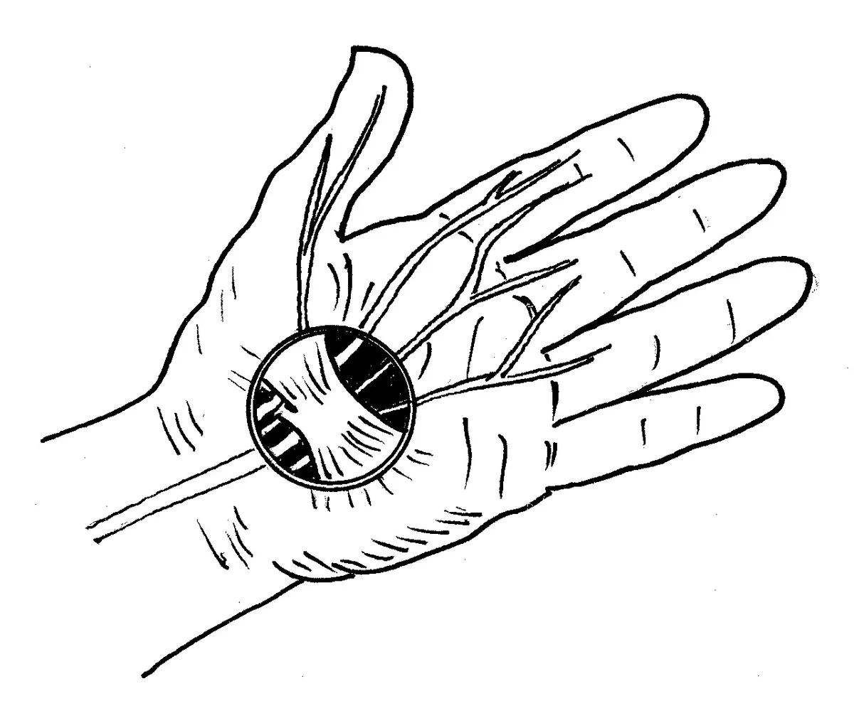 Carpal Tunnel 